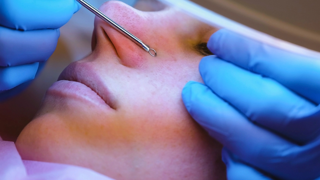 Depositphotos_240704804_XL_1024 Mitesser professionell entfernen lassen